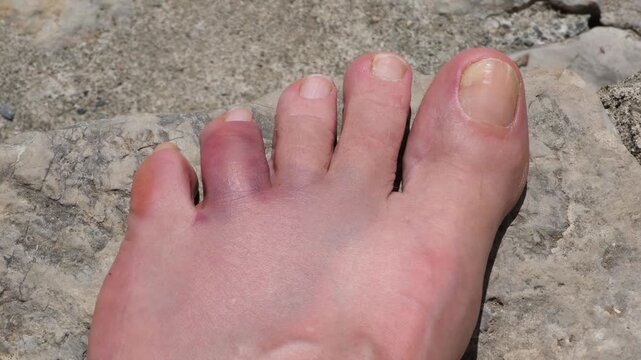A swollen and bruised toe after accidentally hitting a rock on a beach vacation. Foot injury concept, accident, first aid, healthcare, and recovery.