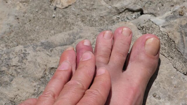 A swollen and bruised toe after accidentally hitting a rock on a beach vacation. Foot injury concept, accident, first aid, healthcare, and recovery.