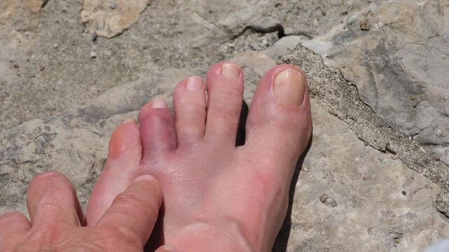 A swollen and bruised toe after accidentally hitting a rock on a beach vacation. Foot injury concept, accident, first aid, healthcare, and recovery.
