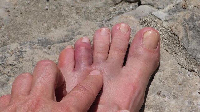A swollen and bruised toe after accidentally hitting a rock on a beach vacation. Foot injury concept, accident, first aid, healthcare, and recovery.