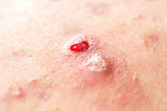 Abscess with bleeding drainage. Boil and pus on epidermis. Skin abscess affects infected skin. Medical dermatology macro detail.