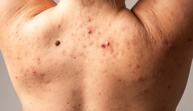 Boil with pus and redness. Skin abscess on infected skin. Dermatology closeup of abscess. Visible drainage from boil.