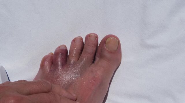 Applying pain relief ointment to an injured swollen toe after hitting a rock during a seaside vacation, concept of first aid, healthcare and recovery.
