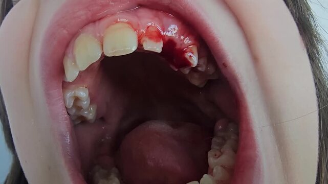 Child shows dental condition with visible cavities and gum issues in a clinical setting during an oral examination