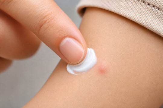 Anti Itch Cream Applied to Child Insect Bite