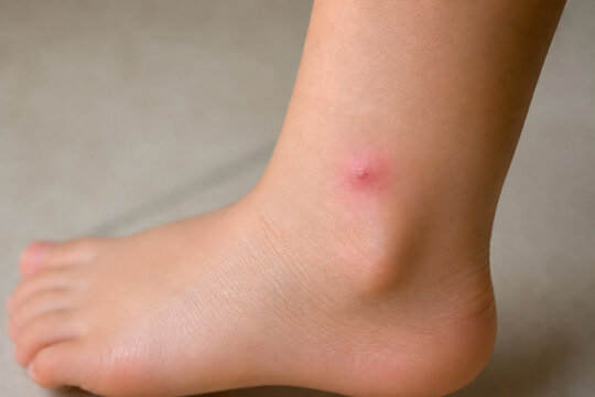 Insect Bite on Child Ankle Close Up