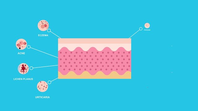 An animated infographic showcasing various skin disorders and infections such as warts, bruises, eczema, and chronic psoriasis suitable for health and beauty advertisements.
