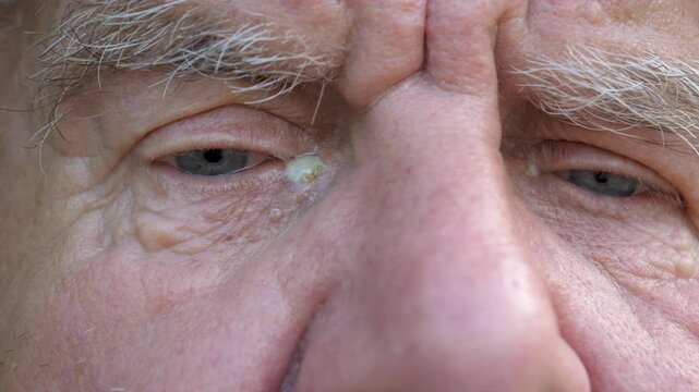 Extreme close up of senior man face with purulent eye infection, likely blepharitis or conjunctivitis. Showing discharge and inflammation on old man eyelid as he slowly blinks