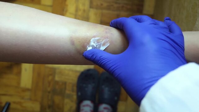 Doctor in blue gloves applies heparin ointment to a large leg bruise on a 10 year old boy. Medical treatment for hematoma resorption and skin injury first aid concept.