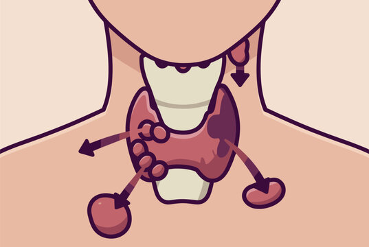 Medical illustration of a human thyroid gland showing nodules and possible cancer spread to surrounding lymph nodes.