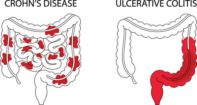 Inflammatory bowel disease vector illustration comparing Crohn's disease and ulcerative colitis