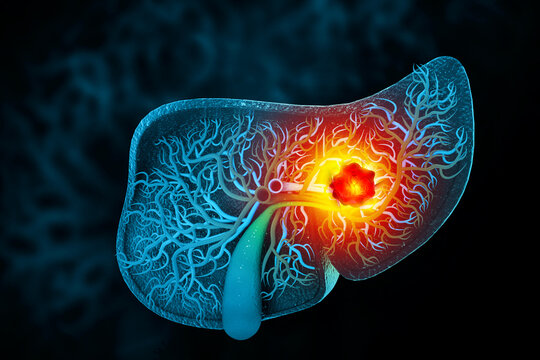 Liver cancer or liver tumor, Hepatocellular carcinoma (HCC), causes, symptoms, treatments, 3d illustration