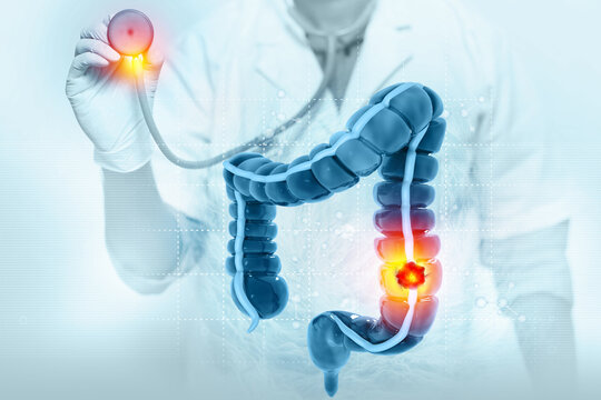 Colon cancer. Cancer attacking cell. Colon disease concept. 3d illustration