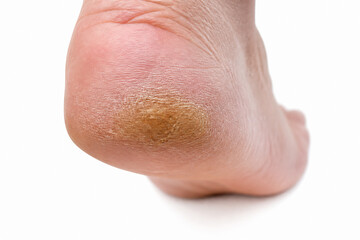 Fototapeta premium A close-up of a human foot with a patch of brown discoloration on the sole.