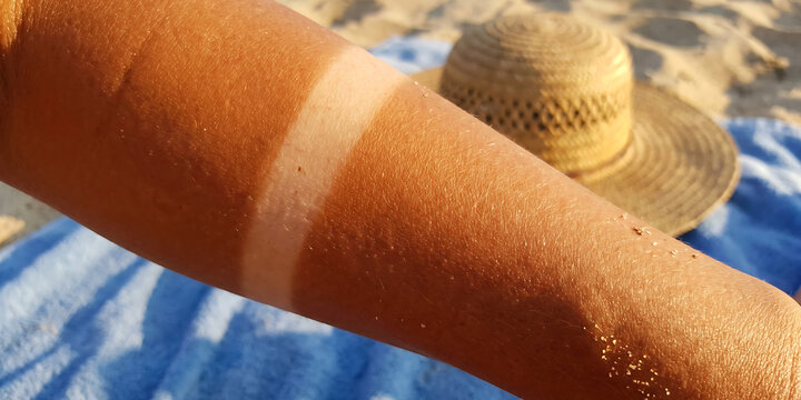 Tan line on human arm showing contrast between sunbathed skin and pale area after spending time outside under bright summer solar rays.