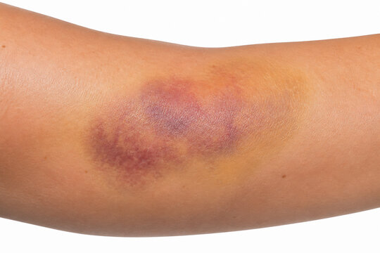 A close-up of a person's arm displaying a reddish, purplish rash or bruise.