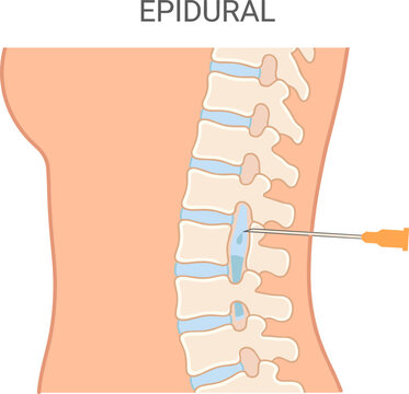  epidural anesthesia procedure in spinal column