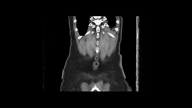 Contrast-Enhanced CT Abdomen and Pelvis Hepatic Venous Phase Coronal 1.25 mm DICOM Medical Imaging Anatomy Loop