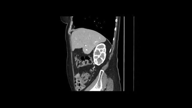 Contrast-Enhanced CT Abdomen and Pelvis Hepatic Venous Phase Sagittal 1.25 mm DICOM Medical Imaging Anatomy Loop