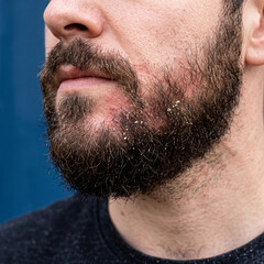 Fototapeta premium Beard of a man shows clear evidence of skin flaking and redness surrounding the chin and mouth area indicating a need for targeted skincare or professional dermatological treatment for skin health.