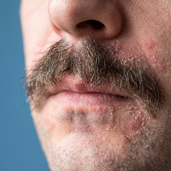 Naklejka premium Mustache region displays flaky skin and significant irritation on a male subject who might be suffering from common facial dermatosis or environmental sensitivity requiring medical diagnosis.