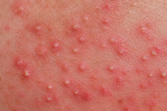 Close up of inflamed skin with acne pustules