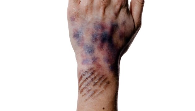 Defensive wound bruising pattern on forearm. Dorsal view forensic medical documentation photography on neutral background.