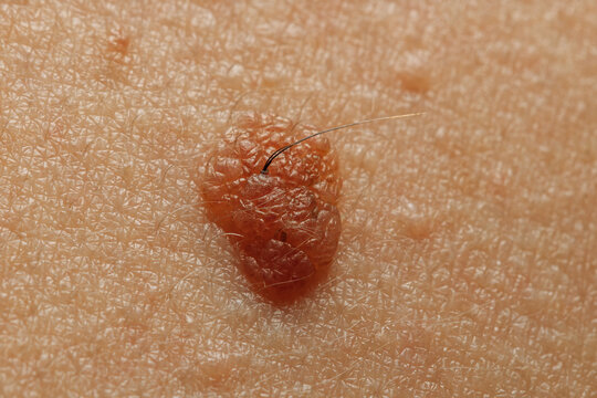 Macro close-up of a benign nevus or papilloma on Caucasian skin.