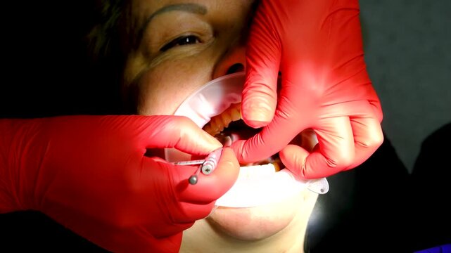 Dental implant crown placement using cheek retractor implant screwdriver and saliva ejector followed by patient smiling at beautiful treatment result in mirror