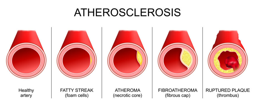 Atherosclerosis evolution. Stages of development of atheromatous plaques in the walls of arteries. Arteriosclerosis of coronary artery.