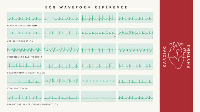 Ecg waveform reference chart showing various cardiac rhythms for medical study