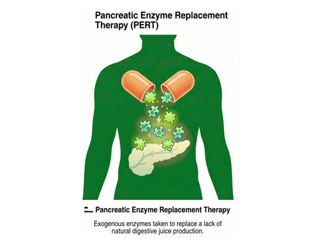 Pancreatic enzyme replacement therapy illustration depicts the medical administration of exogenous enzymes to replace a lack of natural digestive juice production in the human body for digestion.