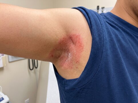 Intertrigo Pictures Showing Skin Fold Rash, Redness, Irritation, Moisture-Related Inflammation, Medical Reference, Healthcare Education, and Awareness