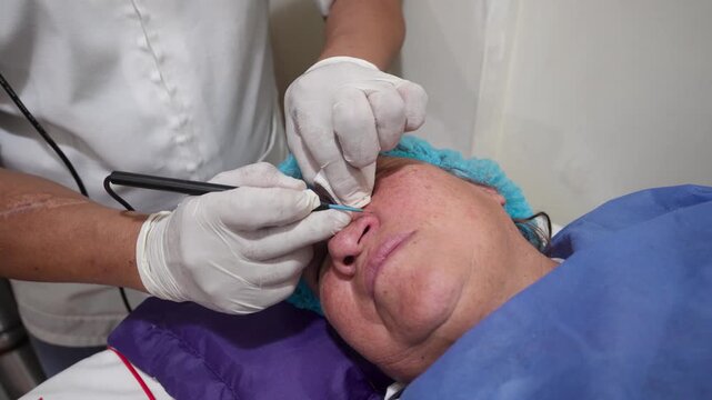 Dermatologist performing electrocautery wart removal on nose during minor skin surgery