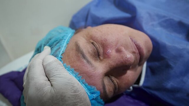 Specialist performing electrocautery treatment on a facial wart providing dermatological care