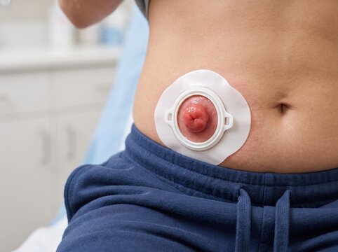 Stoma Pictures Showing Ostomy Anatomy, Abdominal Surgical Opening, Medical Reference, Healthcare Education, Patient Care, and Clinical Awareness