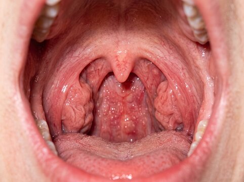 Picture of Tonsils Showing Healthy Throat Anatomy, Oral Cavity Structure, Medical Reference, Healthcare Education, and Clinical Awareness Information