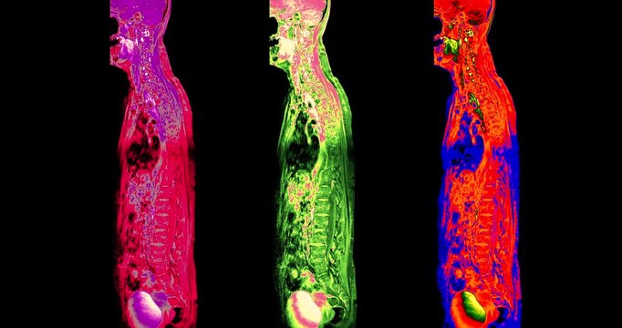 Colorized red and cream MRI sagittal scan of the human cervical spine and skull base rotating on black background medical animation.