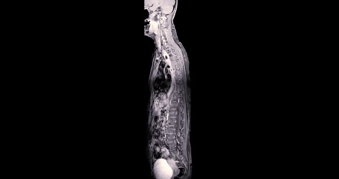 Colorized orange and red MRI coronal image of the human cervical spine neck and skull base on black background medical animation.