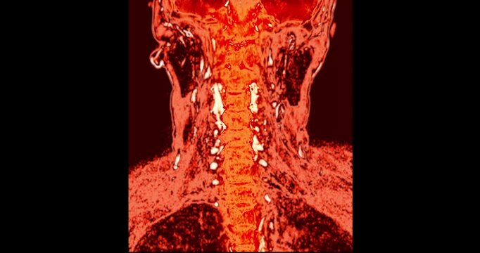 Grayscale magnetic resonance imaging sagittal scan of the entire human spine from head to pelvis on black background vertical medical animation.