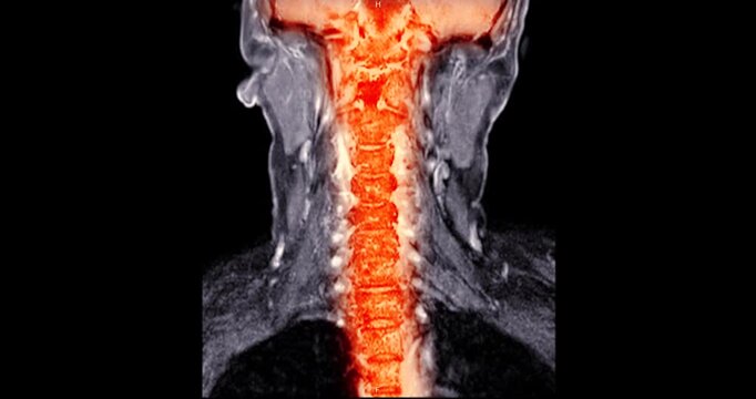 Colorized red and orange MRI coronal maximum intensity projection of the human cervical spine and neck vessels on black background.