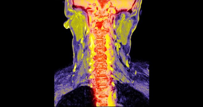 Colorized red MRI sagittal projection alongside axial cross sections of the human cervical spine on black background medical animation.