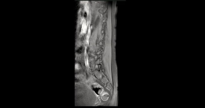Grayscale T1 weighted fat saturated MRI sagittal scan of the human lumbar spine and lower back on black background.