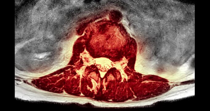 Colorized red and fire toned MRI axial T2 cross section of the human lumbar spine and vertebra on black background.