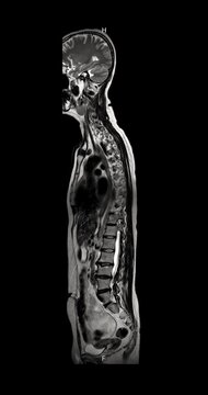 Grayscale T2 weighted MRI sagittal scan of the entire human spine and body from head to pelvis on black background vertical animation.