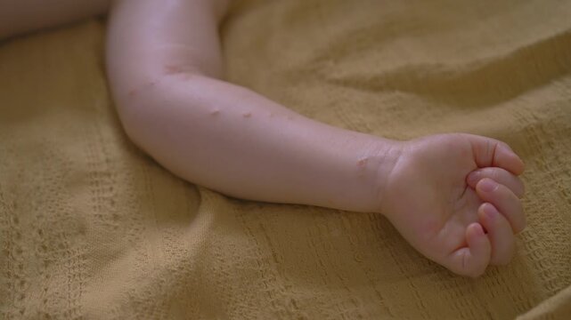 Child hand covered with red spots and small blisters. Close-up.
