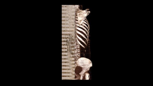 3D volume rendered CT scan reconstruction of human dorsolumbar spine thoracic vertebrae rib cage and pelvis