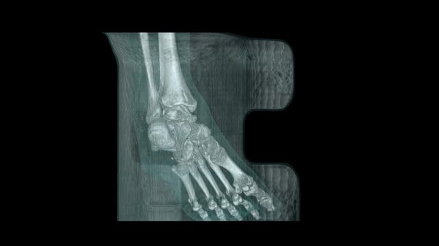 CT scan reconstruction of human left ankle and foot bones with translucent teal soft tissue contour overlay