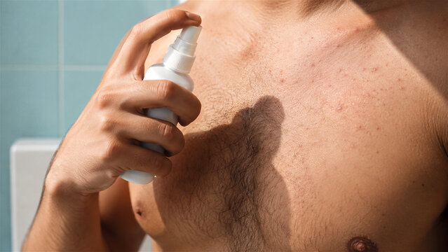 man using spray bottle on skin with acne. Young person applying medical treatment to chest for body rash. Dermatological skin care, health care concept in bathroom
