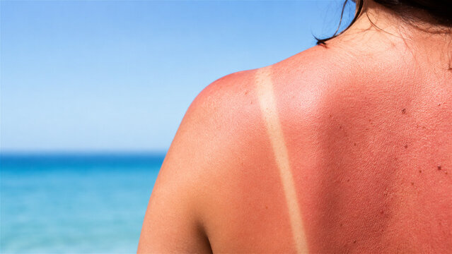 woman with red sunburn on shoulder after beach day. Skin irritation with visible tan line. Concept of protection against ultraviolet light and danger of excessive exposure to solar heat